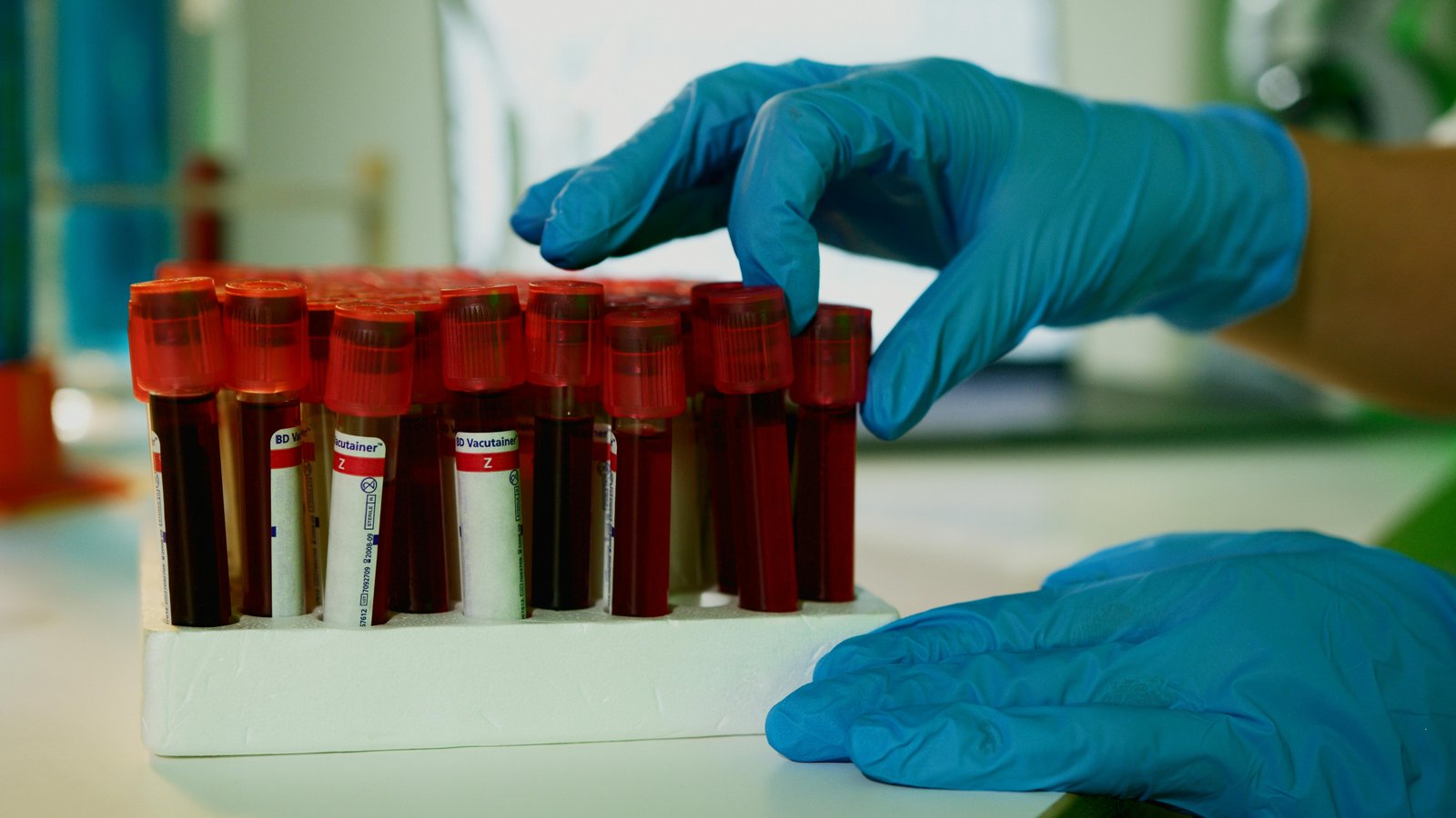 Utility of CBC-derived ratios in the diagnosis and prediction of active tuberculosis in people with rheumatic diseases