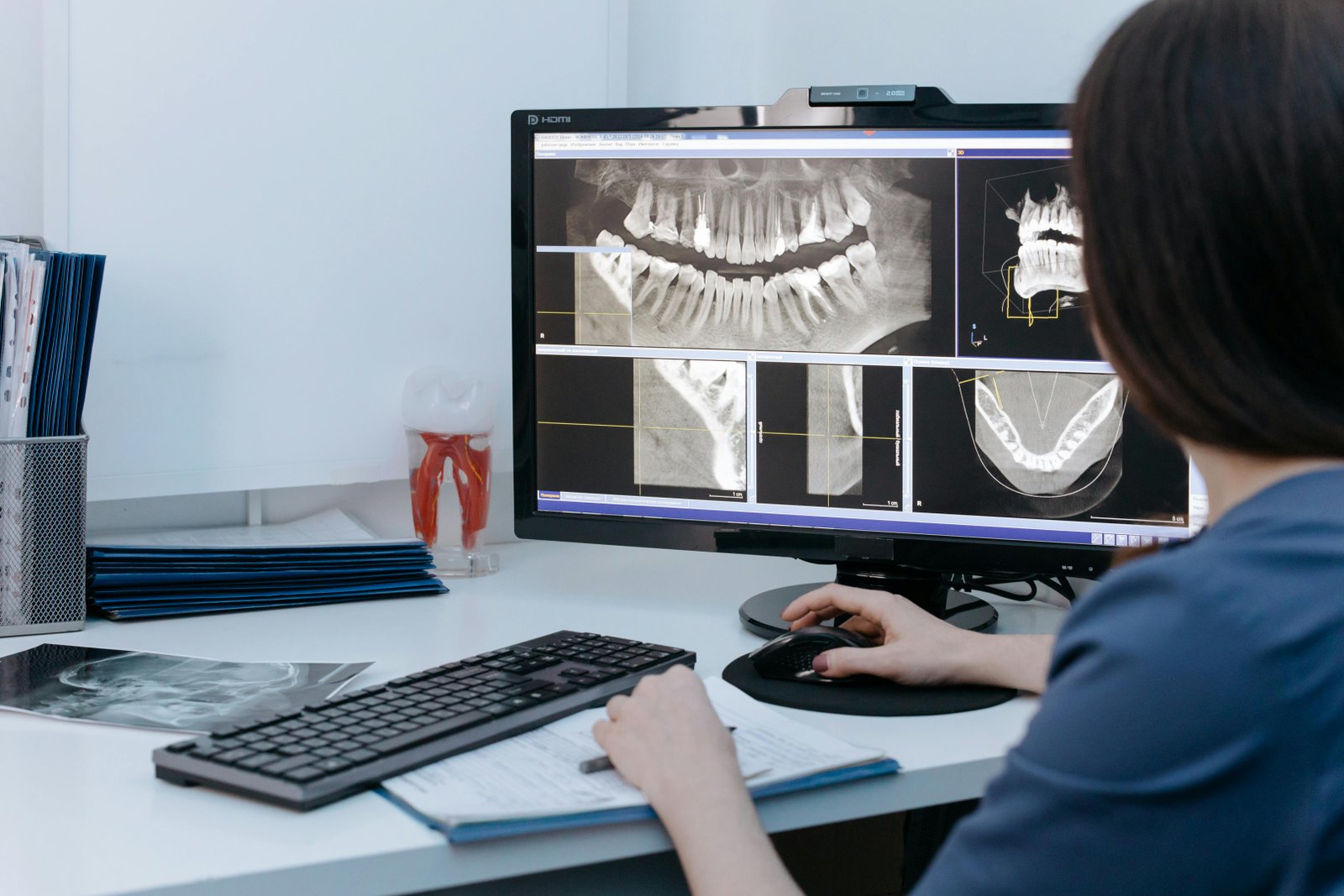 Facial recess size estimation using sagittal slices on cone-beam CT for cochlear implantation